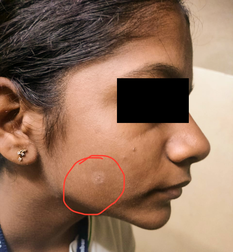 White Spots On The Face In Children Nathani Clinic