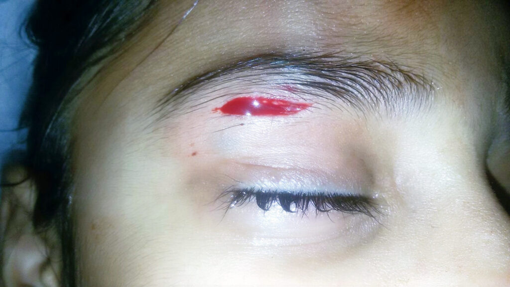 Cut near right eyebrow