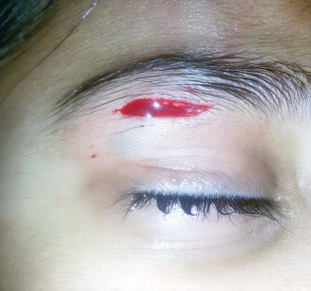 Cut near right eyebrow