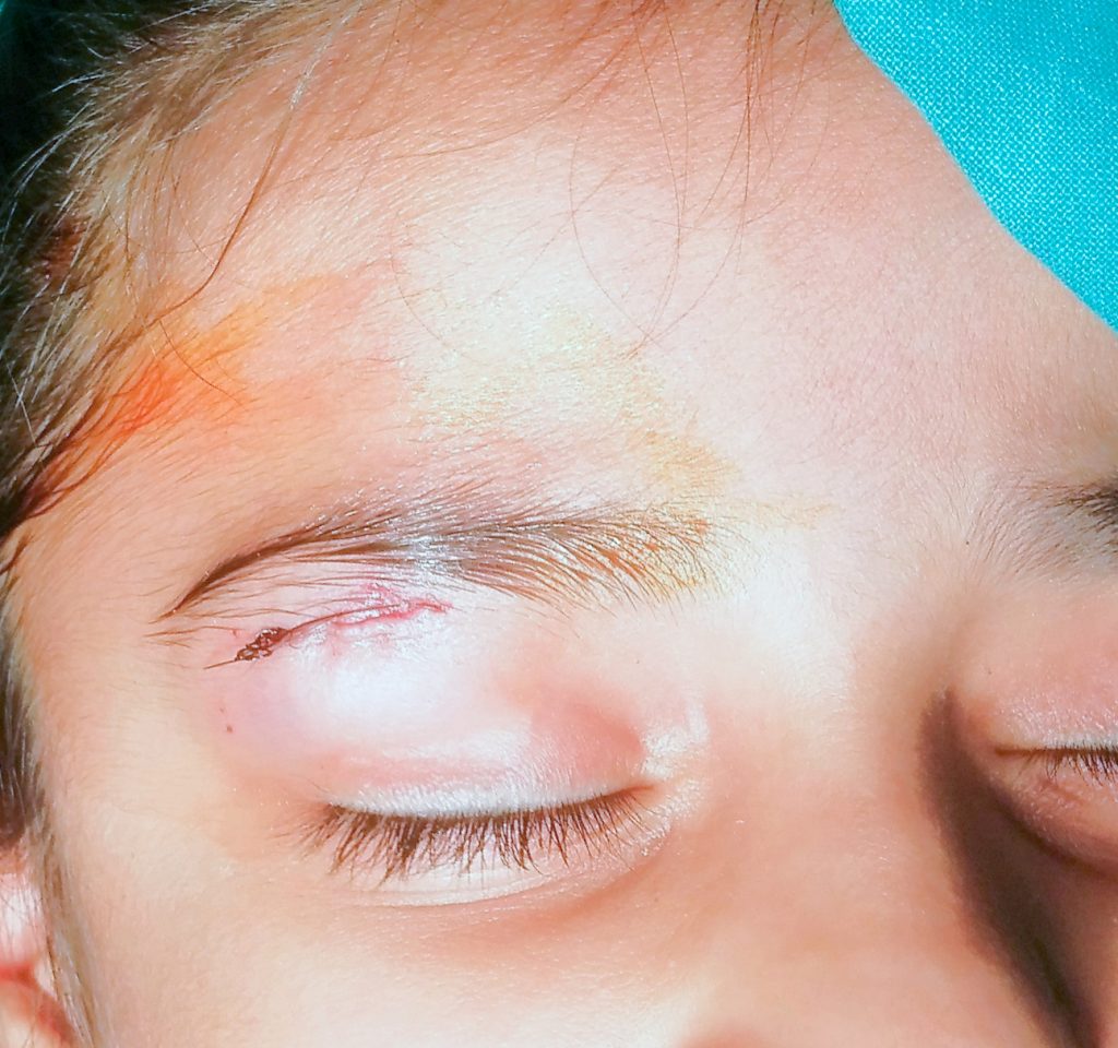 Sutured cut near right eyebrow